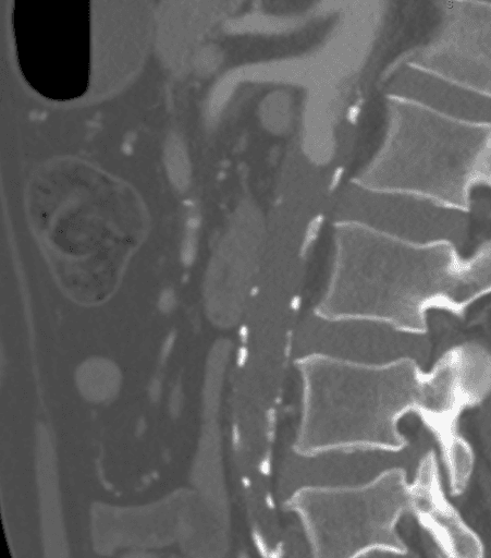CTA, die zeigt, dass sich das Atherom proximal bis zur Höhe der Arteria mesenterica superior (SMA) erstreckte, was die suprar
