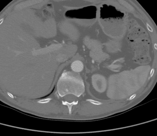 TAC que muestra que la aorta supracelíaca estaba libre de enfermedad arterial.