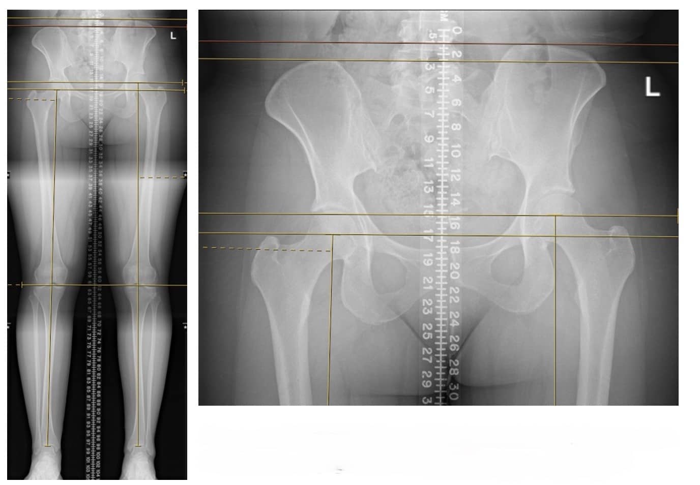 Präsentationsbilder mit einer Beinlängenabweichung von 17 mm (rechts kürzer als links), aus dem Oberschenkelknochen.Letzte Na
