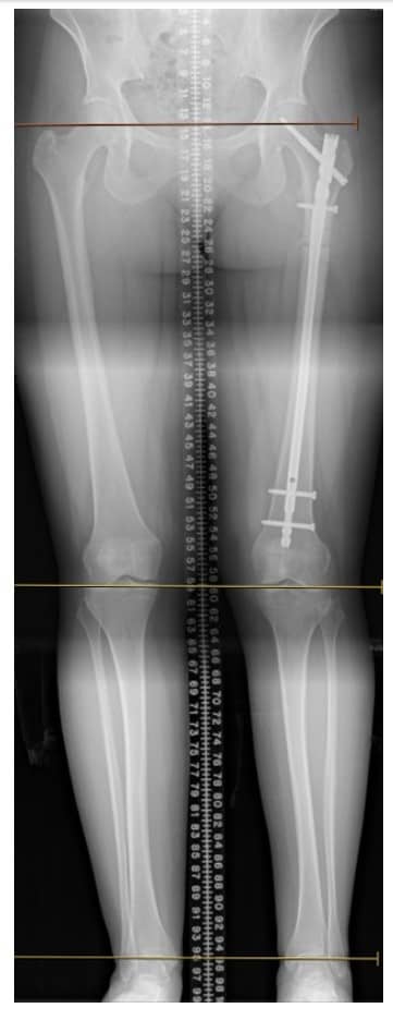 Präsentationsbilder mit einer Beinlängenabweichung von 17 mm (rechts kürzer als links), aus dem Oberschenkelknochen.Letzte Na