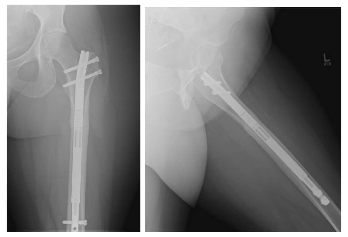 Präsentationsbilder mit einer Beinlängenabweichung von 17 mm (rechts kürzer als links), aus dem Oberschenkelknochen.Letzte Na