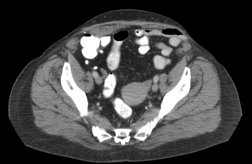 Axiale Ansicht eines CT-Abdomenbeckens dieses Patienten, das eine Schnitthernie mit partieller Dicke des linken unteren Quadr