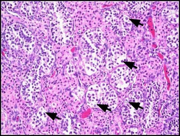 et al.et al.et al.et al.et al.et al.et al.et al.et al.et al.12Neoplasia de células germinales in situ (GCNIS). Se ven grandes