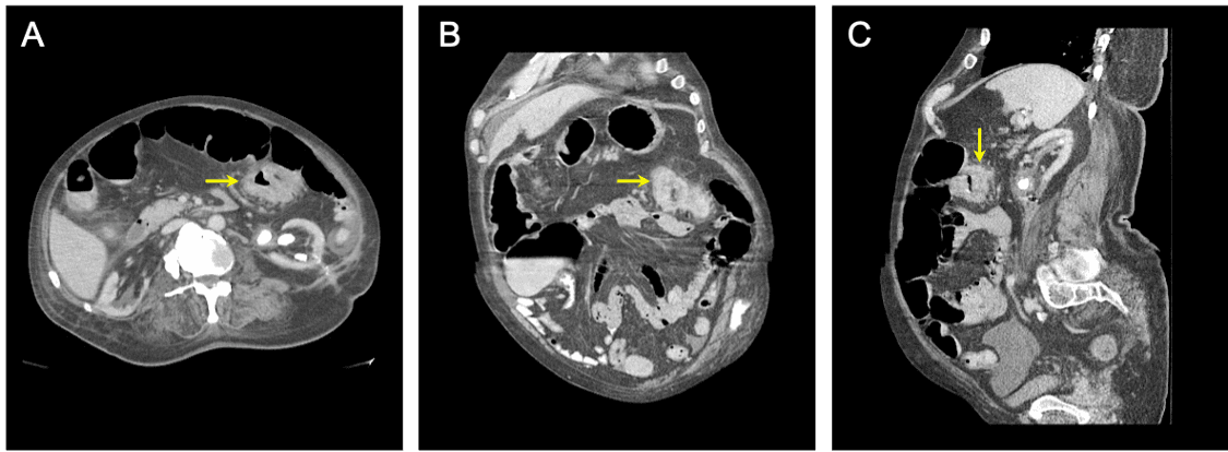 CT-Untersuchung des Abdomens und des Beckens mit intravenösem und oralem Kontrastmittel, die Hinweise auf eine obstruktive tr
