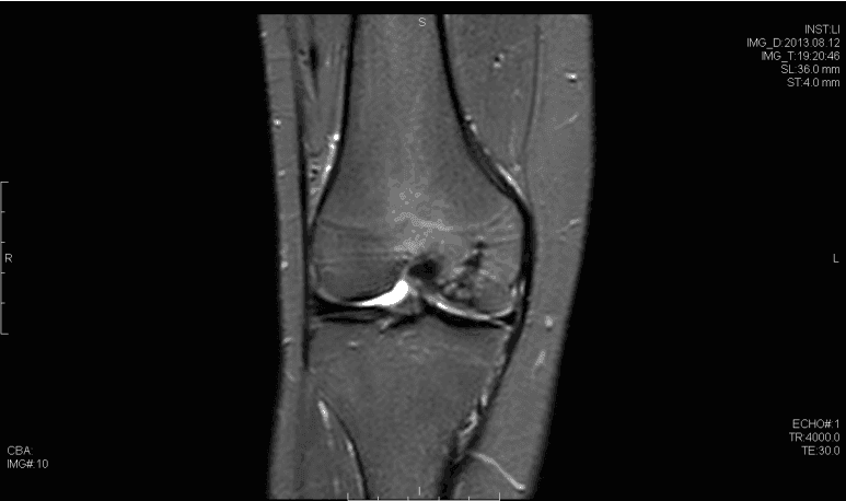 STIR Imágenes por resonancia magnética que demuestran un defecto osteocondral