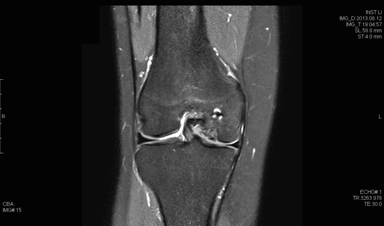 Resonancia magnética Coronal T2 que demuestra defecto osteocondral