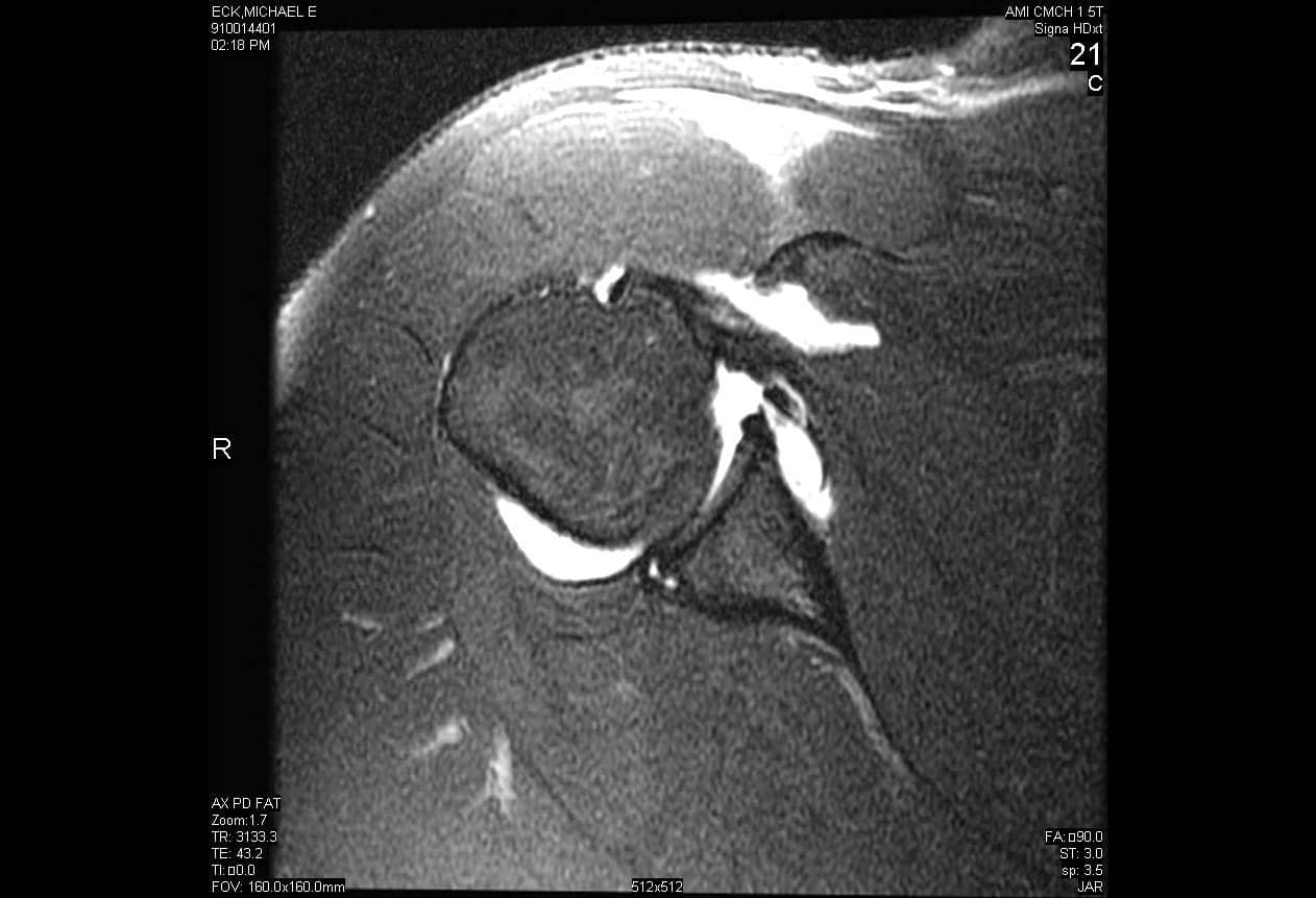 Saturación de grasa coronal con densidad de protones