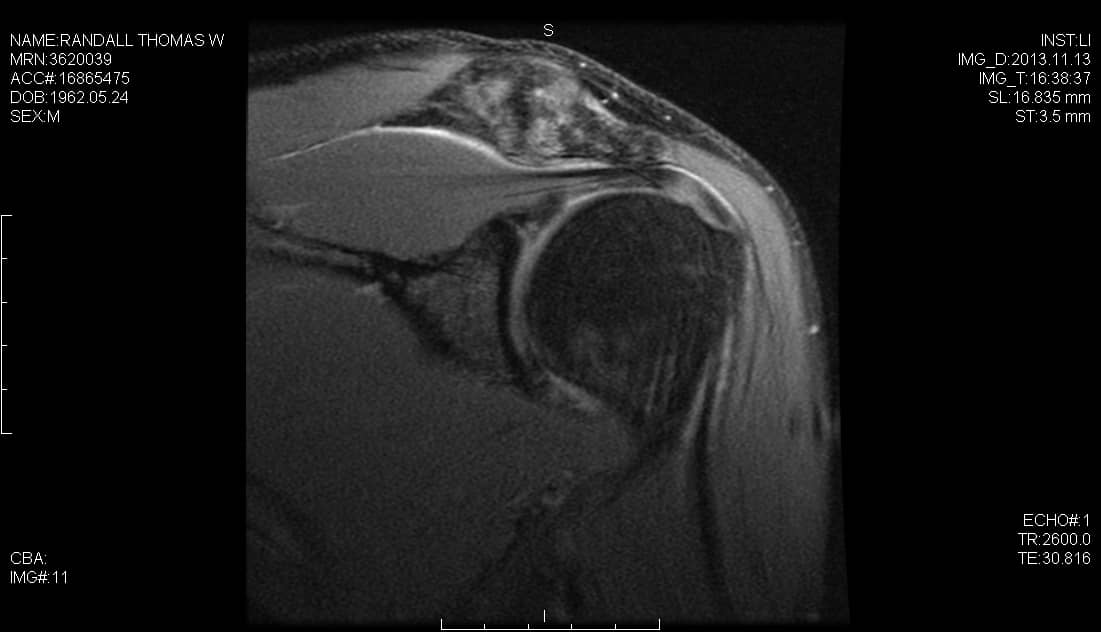 Saturación de grasa coronal con densidad de protones