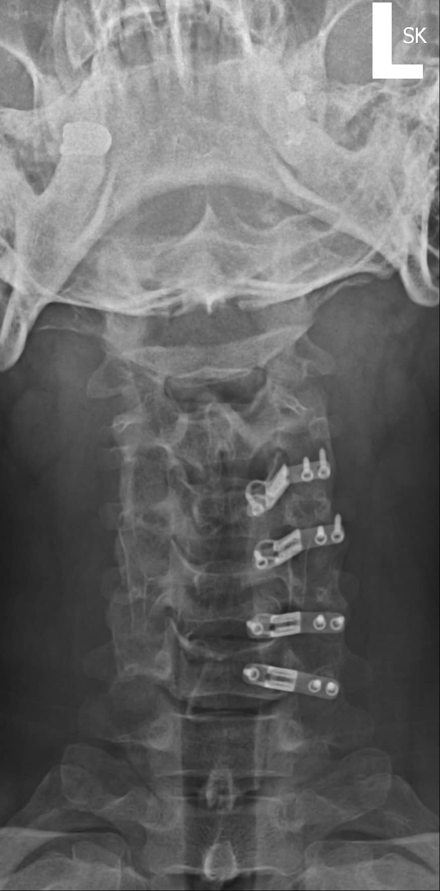 AP columna cervical