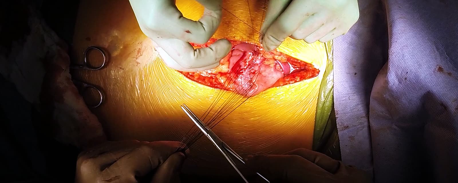 open-antrectomy-and-duodenal-resection-for-neuroendocrine-tumor