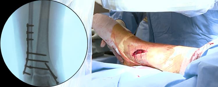 open-reduction-internal-fixation-bimalleolar-ankle-fracture