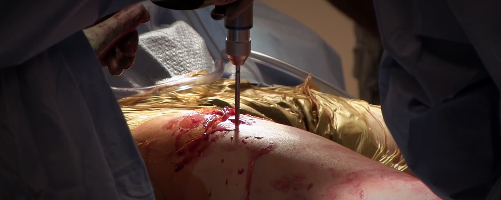 retrograde-femoral-intramedullary-nail-periprosthetic-fracture