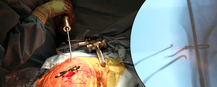 closed-cephalomedullary-nailing-subtrochanteric-hip-fracture