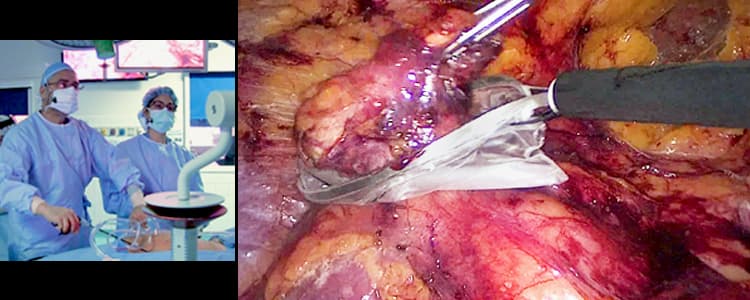 left-laparoscopic-transperitoneal-adrenalectomy-for-aldosteronoma