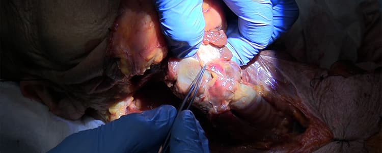 review-of-partial-laryngectomy-techniques-and-demonstration-of-the-supracricoid-laryngectomy-with-cricohyodoepiglottopexy-cadaver