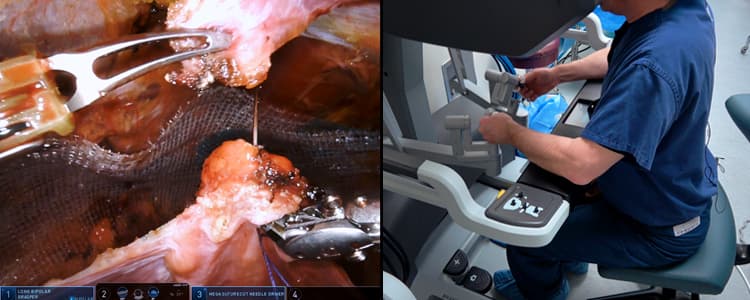 robotic-assisted-laparoscopic-rtapp-bilateral-inguinal-hernia-repair