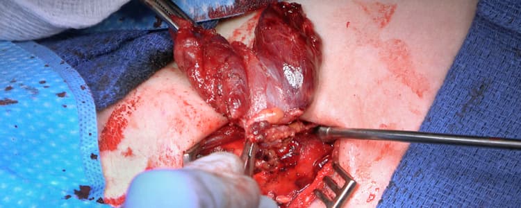 open-total-thyroidectomy-and-central-neck-dissection-for-papillary-thyroid-cancer-in-the-setting-of-hashimotos-thyroiditis