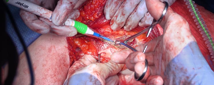 open-incisional-hernia-repair-with-mesh-and-unilateral-posterior-component-separation-with-excision-of-unstable-scar