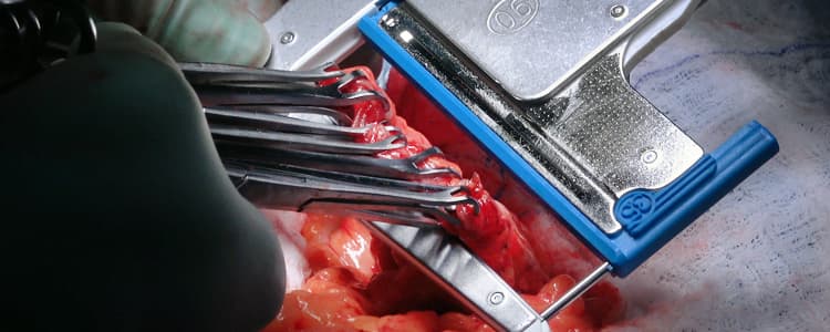 laparoscopic-assisted-right-hemicolectomy