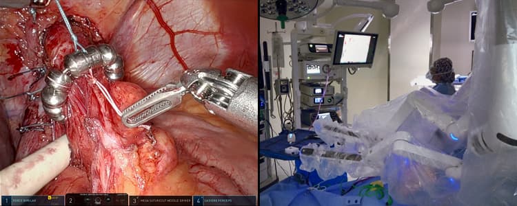 robotic-paraesophageal-hernia-repair-with-magnetic-sphincter-augmentation-using-the-linx-device