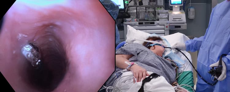esophagogastroduodenoscopy-egd-with-placement-of-a-bravo-probe-for-ph-and-gerd-symptom-monitoring