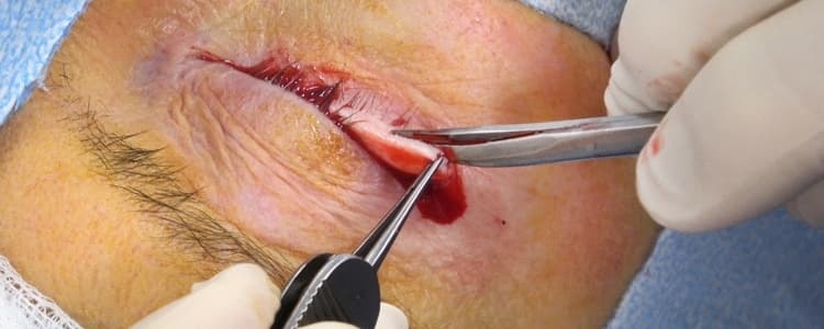 lateral-tarsal-strip-procedure-for-right-lower-eyelid-entropion