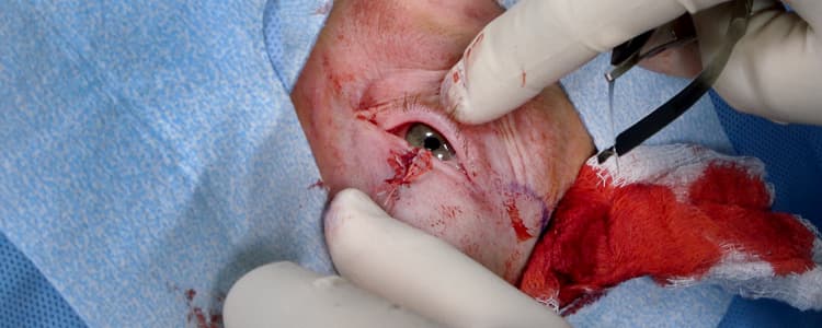 lower-eyelid-full-thickness-lid-margin-repair-for-8-mm-defect-following-mohs-surgery-for-basal-cell-carcinoma