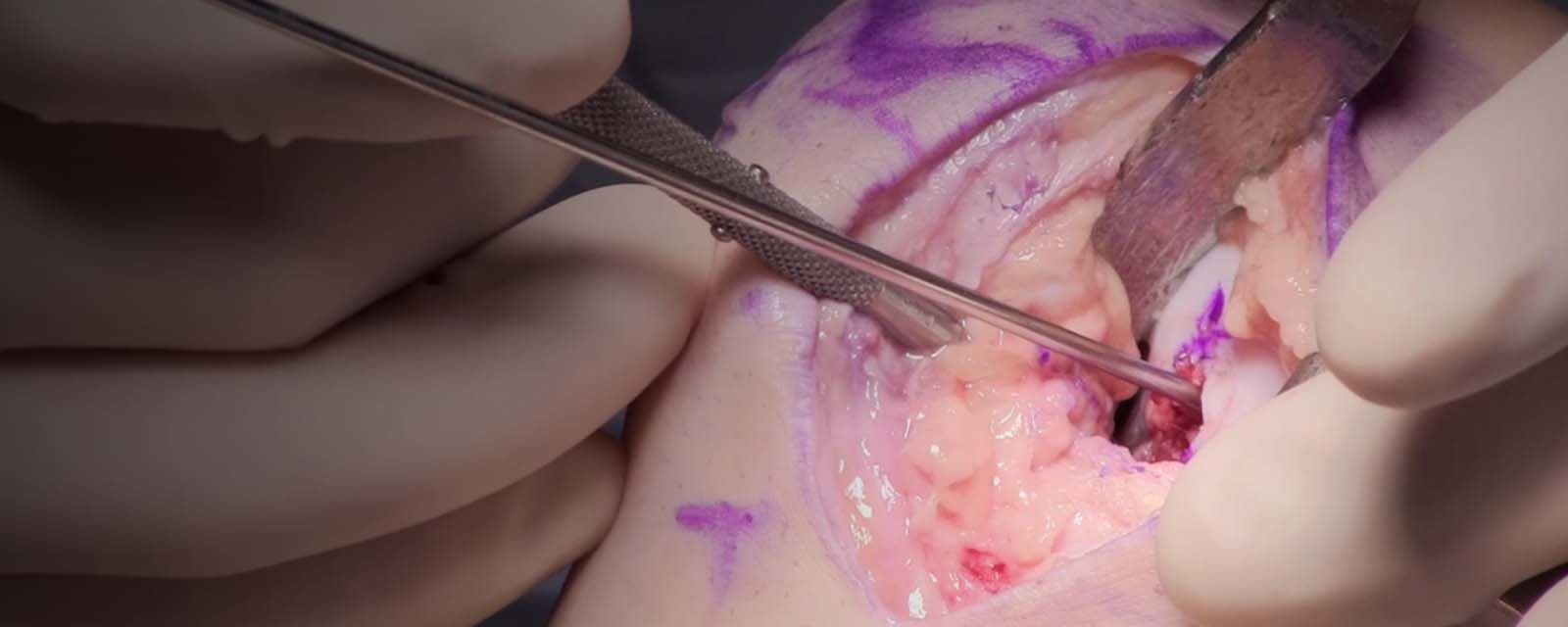 femoral-resurfacing-with-an-osteochondral-allograft-for-osteochondritis-dissecans